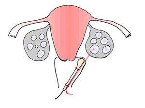 多囊卵巢患者如何提高供卵试管婴儿的成功率？