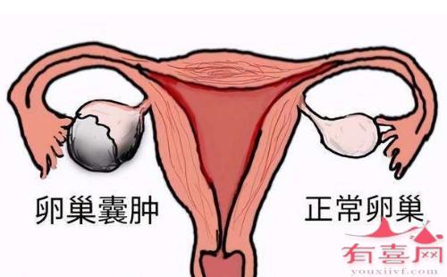 卵巢囊肿和多囊卵巢的区别是什么？