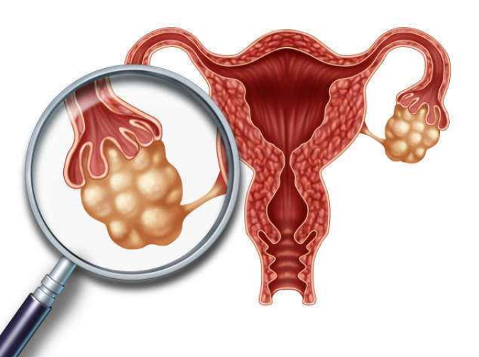 卵巢囊肿有哪些性质