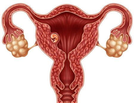 子宫内膜息肉能做试管婴儿吗