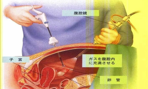 得了输卵管结核能做手术吗