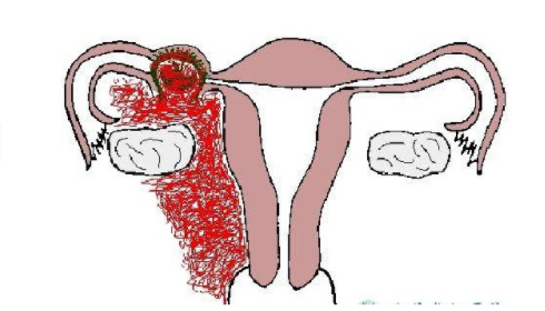 女性输卵管妊娠的结局有哪些