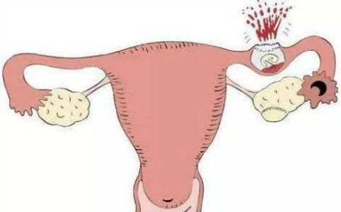 女性输卵管妊娠破裂是什么意思
