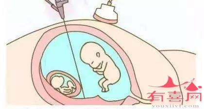 原来多胎妊娠减胎是这么回事