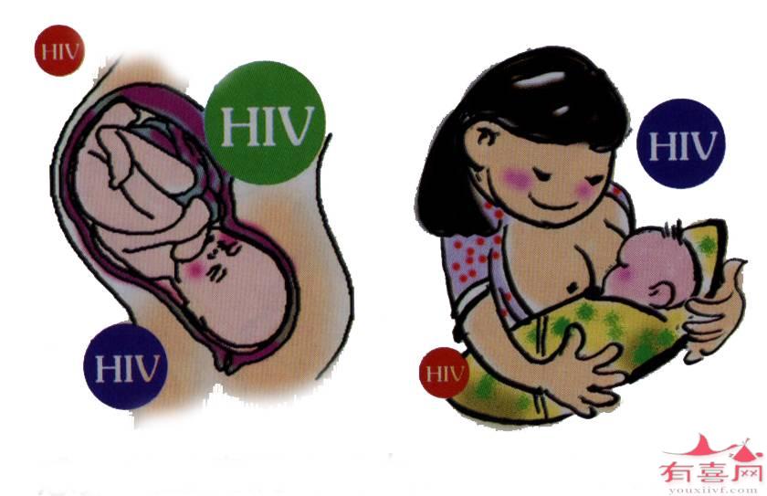 艾滋病（hiv）病毒载量130能做试管婴儿吗