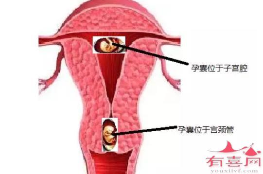 孕妇怀孕宫颈图图片