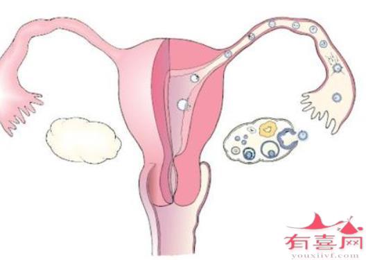 详解单侧输卵管堵塞的治疗方法是什么