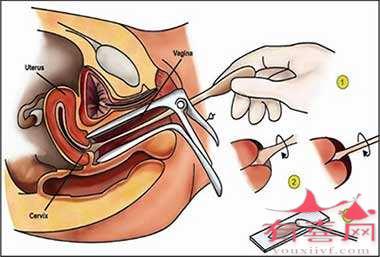 宫颈抹片是什么检查