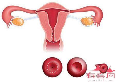 子宫内膜异位症的症状有哪些