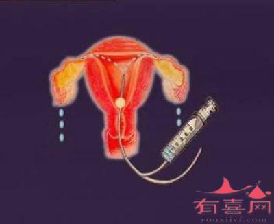 女性输卵管通液一般做几次