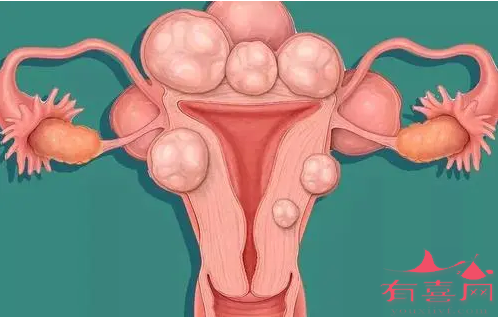 子宫肌瘤早期症状有哪些