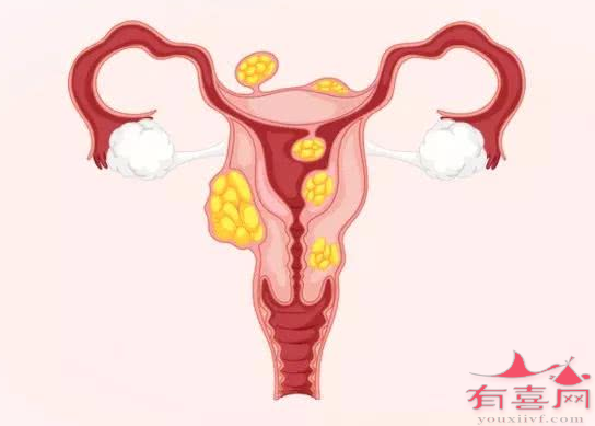有子宫肌瘤会不会影响怀孕