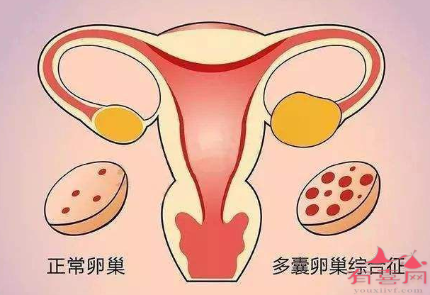 多囊卵巢有什么方法可以怀孕