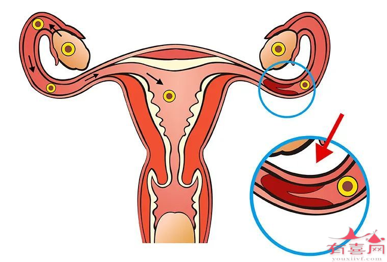 输卵管堵塞是做疏通手术还是试管婴儿