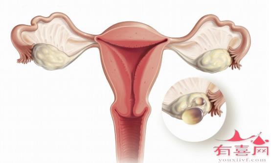 卵巢性闭经能促排怀孕吗