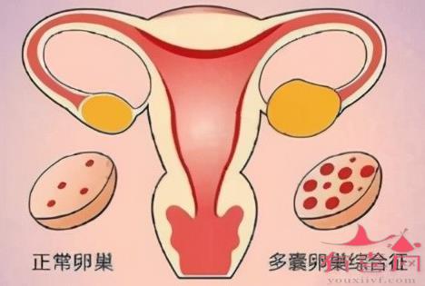 双侧卵巢多囊样改变是什么意思严重吗