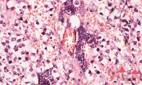 精原细胞瘤是什么病