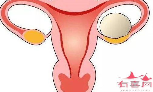 卵巢囊肿能怀孕吗