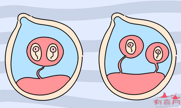试管婴儿生双胞胎的几率高吗