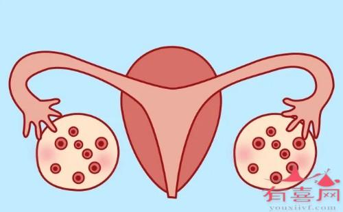 多囊卵巢备孕如何调理