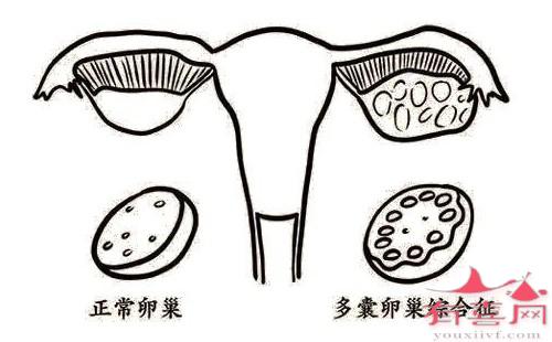 多囊卵巢是怎么形成的