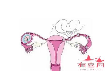 引起宫颈妊娠的几大原因，需警惕