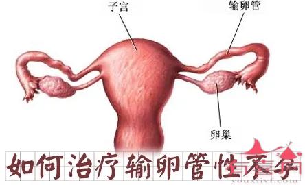 关于输卵管性不孕的治疗，你知道多少