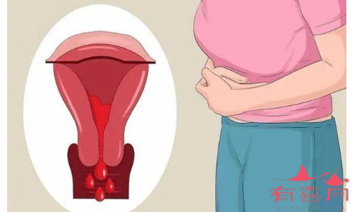 排卵期出血是什么原因造成的