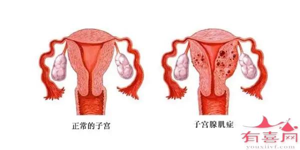 子宫局限性腺肌症是什么意思